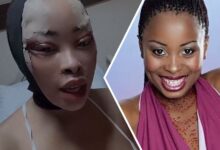 Khanyi Mbau Undergoes Cosmetic Surgery, Buys a "New Face"